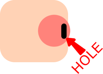 Inverted Nipples's image