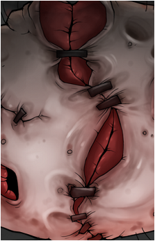 Fistula's image