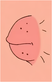 Doug the Pimple